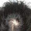 チャップアップで育毛を実践して発毛効果の実験 No.1　頭頂部写真をＵＰ