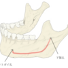 親知らず抜歯