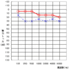 左耳手術後、１年４ヶ月後の診察