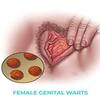 زگیل واژن چیست؟علائم و نشانه های آن و روش های درمانی برای از بین بردن آنها