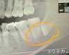 顎骨嚢胞の手術と入院②〜検査から入院