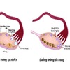 Biểu hiện nhận biết buồng trứng đa nang là gì khám và điều trị thế nào?