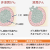 ガン保険に入っていたのに乳がんでも保険がおりない？