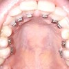 歯科矯正①〜顎の位置と装置装着〜