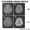 MERS: clinically mild encephalitis/encephalopathy with a reversible splenial lesion　 可逆性の脳梁膨大部病変を伴う軽症脳炎/脳症