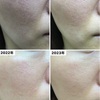 【4年経過画像あり】ヒトプラセンタジェルの効果はいつから出るのか徹底検証
