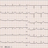 ECG-170：answer