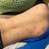 【自閉症児】全身に発疹ができる2