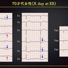 ECG-260：answer