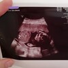 妊娠18週6日目　検診6回目　エコー写真で性別は分かる？