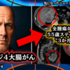 ◆ステージ4大腸がんで“全腫瘍縮小”の衝撃データ ～ イベルメクチン＋メベンダゾール＋CBD＋変性シトラスペクチン…3か月で何が起きたのか？55歳男性の最新症例