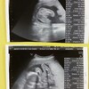 双子妊娠21w3d 性別確定