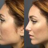 How To Deal With A Rhinoplasty You're Not Happy With