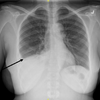 症例75：突然発症の右側胸部痛を訴える43歳女性（J Emerg Med. 2020 Dec;59(6):931-934.）
