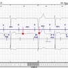 R波が突然消えた～2度房室ブロック～