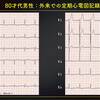 ECG-302：80才代男性。外来での定期心電図記録です。