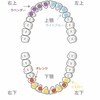 【調整31回目】上顎の隙間がしぶとい