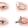 Giải phẫu cắt mắt 2 mí công nghệ hiện đại