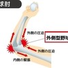 外側型野球肘の症状とケア対策とストレッチ整体のご紹介