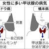 女性に多い病気、甲状腺疾患