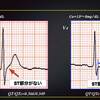 コラム-088：UpToDate : 高Ca血症の心電図での、QT/QTc短縮となるロジックと、その限界性  from コラム-009
