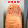 グロームス腫瘍摘出手術：術後313日目。先日の爪の状態の比較写真を作ってみた