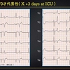 ECG-283：70才代男性。ICUでの不整脈発作です。