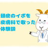 頭皮にできたイボに終止符を打ったセカンドオピニオン