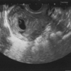 【1度目の妊娠、稽留流産5】10w半ば4回目の妊婦検診で胎芽は確認できないが稽留流産は様子見。