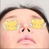 【ザ・リゼン美容外科/鼻整形】鼻尖：鼻中隔延長、鼻柱下降術、斜鼻矯正　症例