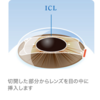 レーシックとICL、どっちがいいの？