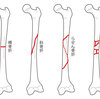   【基礎から学ぶ】骨折の種類【整形外科学】