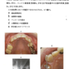 118回歯科医師国家試験【118D-69】歯冠補綴学：ルートエクストルージョン
