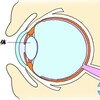白内障について①