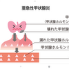 亜急性甲状腺炎と、更年期。