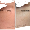 【シミ肝斑】ピコトーニング！1〜２回目の経過と効果を画像で振り返る【口コミ】