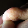  汗疱状湿疹（足の指）その後６