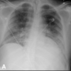 症例61：COVID-19により誘発されたDKA5症例（J Emerg Med. 2020 Nov;59(5):e193-e197.）