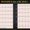 ECG293：80才代女性。嘔吐とめまいでした。心電図が経時的に動きます。