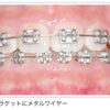 歯科矯正をすることにした〜①抜歯編〜