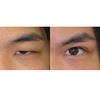 ROOF(ルーフ)切除とは。眼瞼下垂手術と併用してまぶたの重みを減らす。10代男性