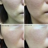 ヒトプラセンタジェル 6本使用後経過写真 アラフォー主婦の薄毛不眠奮闘日記 ヒトプラセンタジェル 6本使用後経過写真 アラフォー主婦の薄毛不眠奮闘日記