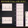 ECG-293：answer
