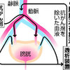 膀胱に高濃度抗がん剤