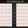 ECG-259：90才女性のふらつきと徐脈です。