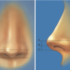 ちょっとマニアックな鼻整形〜鼻の穴、見えたほうが綺麗！？〜