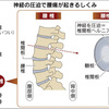 腰痛手術　保存治療で改善も