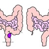 大腸ガンに関する雑学