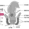 高位前方切除術と低位前方切除術の違い