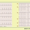 ECG-397：10代男性。無症状で、元気です！